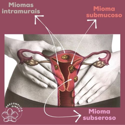 Miomas Uterinos - Uma doença benigna 1 Classificacao Miomas Uterinos